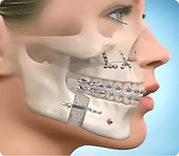 Bucomaxilofacial