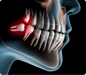 Cirugia Oral Menor